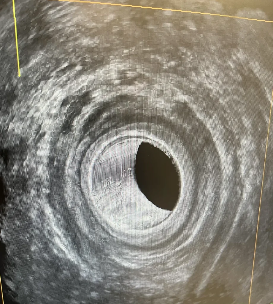 3d ultrasound anal fistula